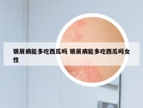 银屑病能多吃西瓜吗 银屑病能多吃西瓜吗女性