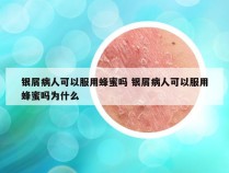 银屑病人可以服用蜂蜜吗 银屑病人可以服用蜂蜜吗为什么