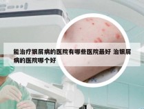 能治疗银屑病的医院有哪些医院最好 治银屑病的医院哪个好