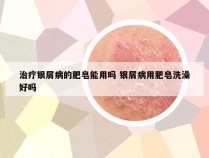 治疗银屑病的肥皂能用吗 银屑病用肥皂洗澡好吗