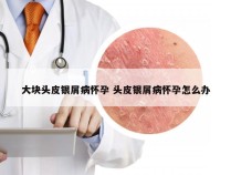 大块头皮银屑病怀孕 头皮银屑病怀孕怎么办