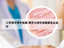 二岁孩子得牛皮癣 两岁小孩牛皮肤癣怎么治疗