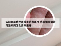 头部银屑病外用激素药怎么用 头部银屑病外用激素药怎么用效果好
