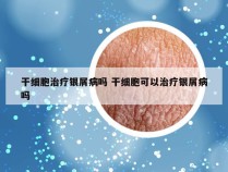 干细胞治疗银屑病吗 干细胞可以治疗银屑病吗