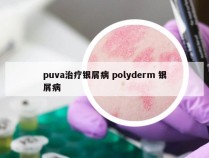 puva治疗银屑病 polyderm 银屑病