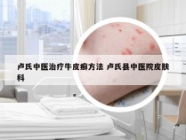 卢氏中医治疗牛皮癣方法 卢氏县中医院皮肤科