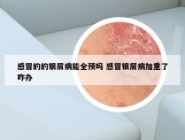 感冒的的银屑病能全预吗 感冒银屑病加重了咋办