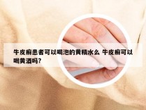 牛皮癣患者可以喝泡的黄精水么 牛皮癣可以喝黄酒吗?