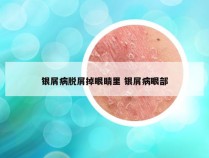 银屑病脱屑掉眼睛里 银屑病眼部