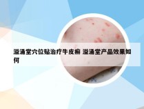 溢涌堂穴位贴治疗牛皮癣 溢涌堂产品效果如何