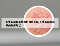 儿童头部银屑病如何治疗论坛 儿童头部银屑病的头屑形状