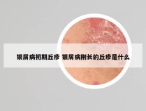 银屑病初期丘疹 银屑病刚长的丘疹是什么