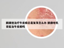 酮康挫治疗牛皮癣总是复发怎么办 酮康唑乳膏能治牛皮癣吗