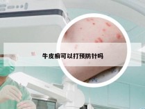 牛皮癣可以打预防针吗