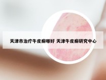 天津市治疗牛皮癣哪好 天津牛皮癣研究中心