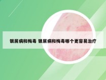 银屑病和梅毒 银屑病和梅毒哪个更容易治疗