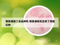 银屑病挠了会水肿吗 银屑病挠完出现了周围红肿