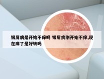 银屑病是开始不痒吗 银屑病刚开始不痒,现在痒了是好转吗