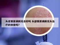 头皮银屑病剃光会好吗 头部银屑病剃光头治疗的快些吗?
