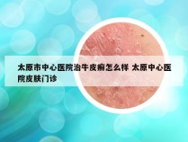 太原市中心医院治牛皮癣怎么样 太原中心医院皮肤门诊