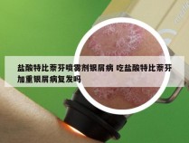 盐酸特比萘芬喷雾剂银屑病 吃盐酸特比萘芬加重银屑病复发吗
