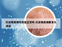 红皮银屑病可恢复正常吗 红皮银屑病要多久消退