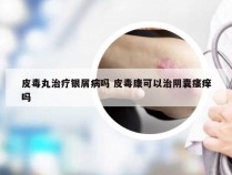 皮毒丸治疗银屑病吗 皮毒康可以治阴囊瘙痒吗