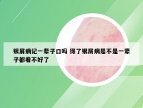 银屑病记一辈子口吗 得了银屑病是不是一辈子都看不好了