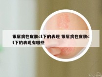 银屑病在皮肤ct下的表现 银屑病在皮肤ct下的表现有哪些