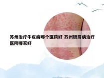 苏州治疗牛皮癣哪个医院好 苏州银屑病治疗医院哪家好