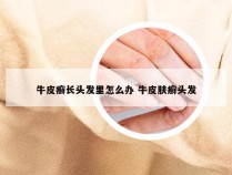 牛皮癣长头发里怎么办 牛皮肤癣头发