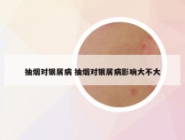 抽烟对银屑病 抽烟对银屑病影响大不大