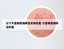 以下不是银屑病典型皮损的是 不是银屑病特征的是
