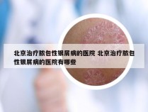北京治疗脓包性银屑病的医院 北京治疗脓包性银屑病的医院有哪些