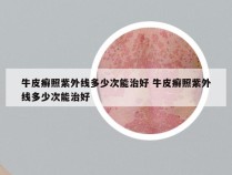 牛皮癣照紫外线多少次能治好 牛皮癣照紫外线多少次能治好
