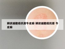鳞状细胞癌抗原牛皮癣 鳞状细胞癌抗原 牛皮癣