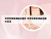寻常型银屑病痊愈图片 寻常型银屑病痊愈图片高清