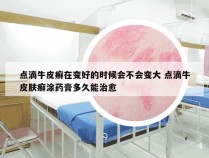 点滴牛皮癣在变好的时候会不会变大 点滴牛皮肤癣涂药膏多久能治愈