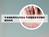 牛皮癣能喝可口可乐么 牛皮癣患者可以喝碳酸饮料吗