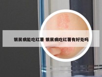 银屑病能吃红薯 银屑病吃红薯有好处吗
