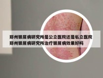 郑州银屑病研究所是公立医院还是私立医院 郑州银屑病研究所治疗银屑病效果好吗