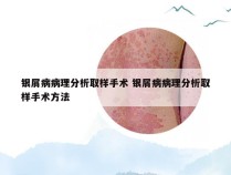 银屑病病理分析取样手术 银屑病病理分析取样手术方法