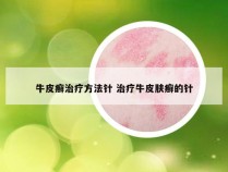 牛皮癣治疗方法针 治疗牛皮肤癣的针