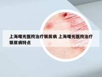上海曙光医院治疗银屑病 上海曙光医院治疗银屑病特点