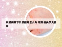 银屑病关节炎腰酸痛怎么办 银屑病关节炎背痛
