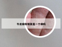 牛皮癣和银屑是一个病吗