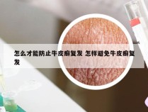 怎么才能防止牛皮癣复发 怎样避免牛皮癣复发