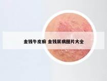 金钱牛皮癣 金钱屑病图片大全