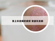 背上长皮癣的症状 背部长皮癣