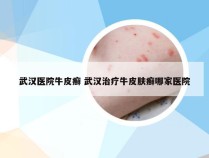 武汉医院牛皮癣 武汉治疗牛皮肤癣哪家医院